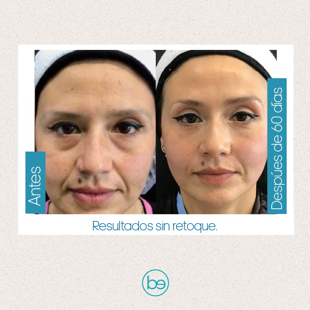 Fusion C, Vitamina C 20%+ Ácido hialuronico