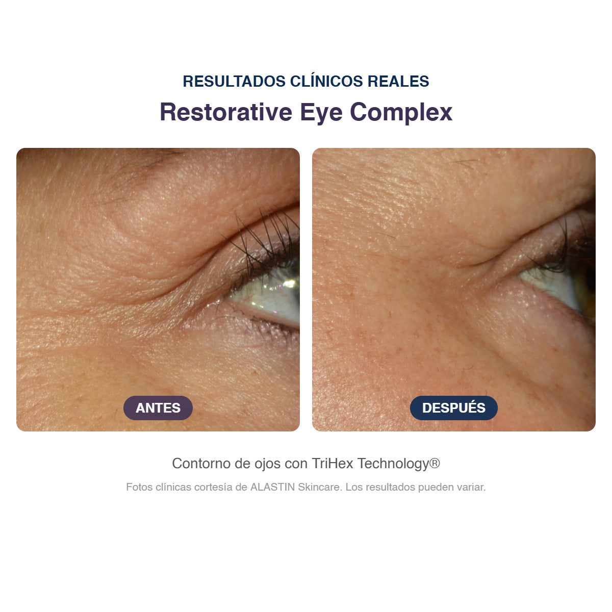 Antes y después ALASTIN Restorative Eye Complex: resultados clínicos en el contorno de ojos