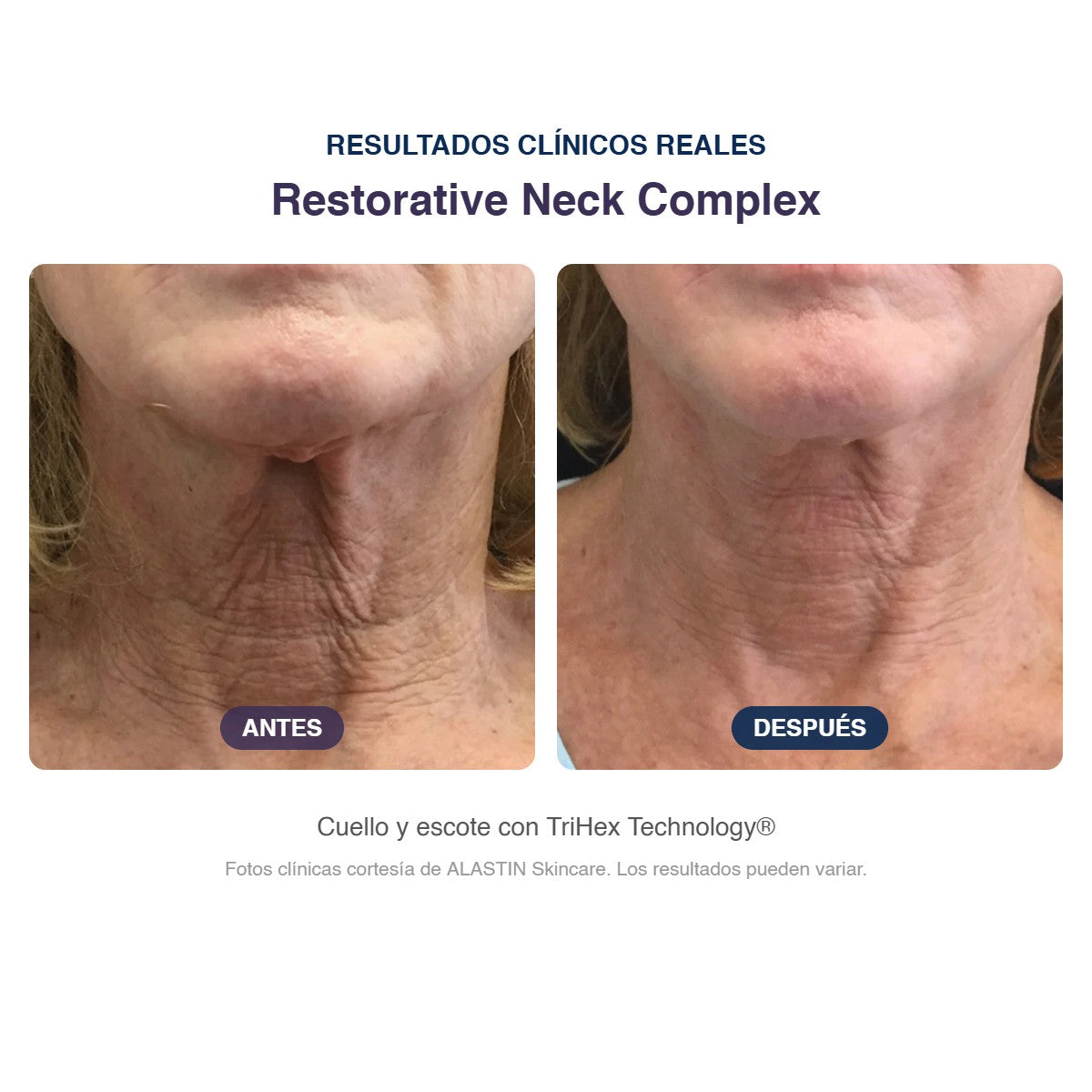 Antes y después ALASTIN Restorative Neck Complex: arrugas del cuello