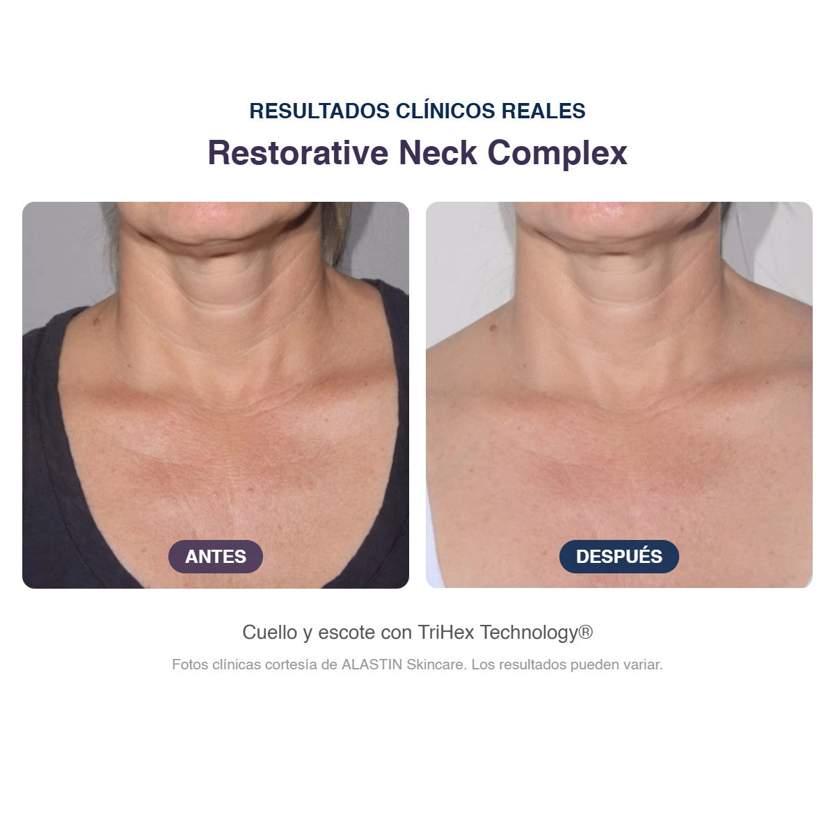 Antes y después ALASTIN Restorative Neck Complex: cuello y escote