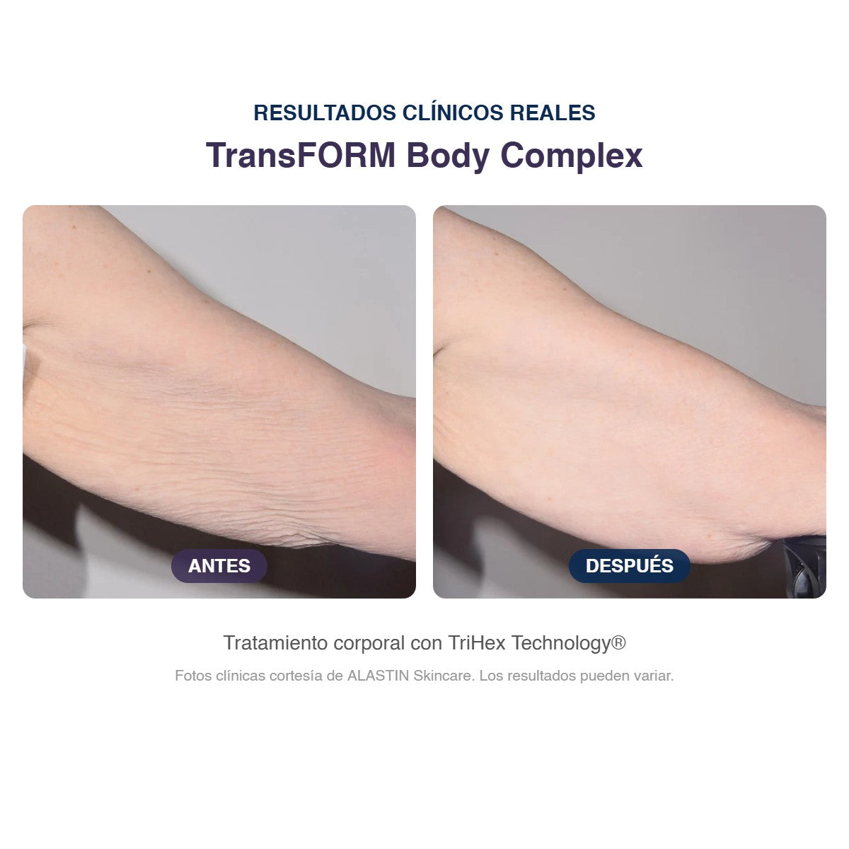 Antes y después ALASTIN TransFORM Body Complex: piel del brazo