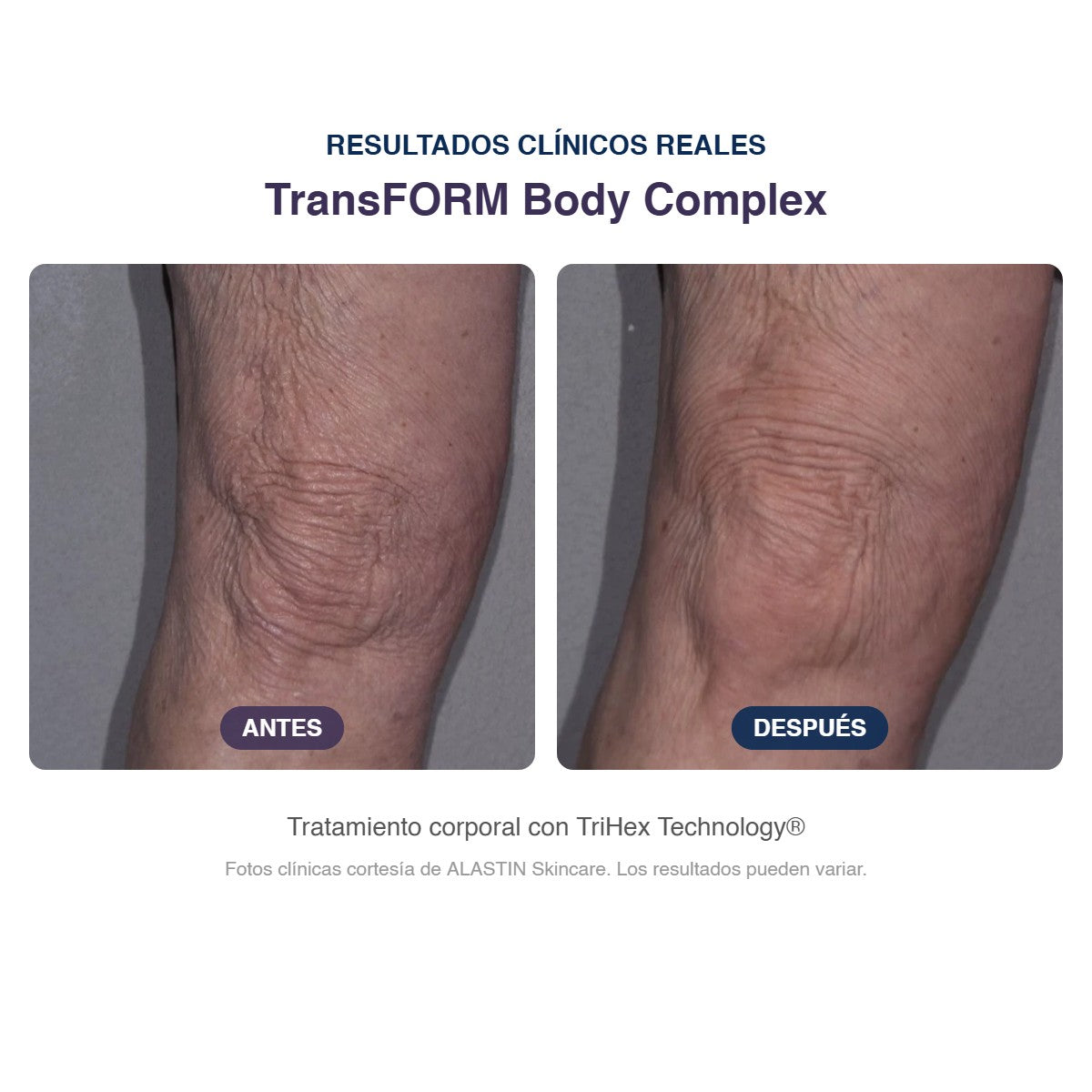 Antes y después ALASTIN TransFORM Body Complex: piel de la rodilla